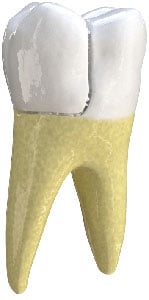 Treatment in Chicago, IL for when a portion of the tooth splits off entirely. Fractured Cusp in Chicago, IL