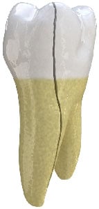Treatment for split tooth in Chicago, IL. Split Tooth in Chicago, IL