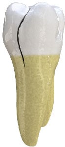 Treatment for a cracked tooth in Chicago, IL. Cracked Tooth in Chicago, IL