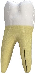 Treatment for fracture of tooth that starts at root extending to crown in Chicago, IL. Vertical Root Fracture in Chicago, IL