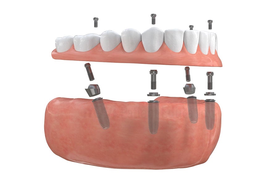 Long-term alternative to dentures from dental expert Dr. Raffi in Chicago, IL. Full Mouth Restoration in Chicago, IL