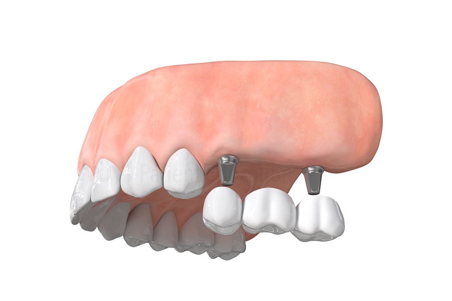 Fix multiple missing teeth with a implant bridge in Chicago, IL. Dental Implant Bridge in Chicago, IL