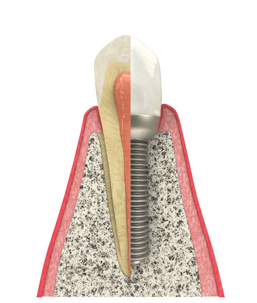 Benefits of Dental Implants in Chicago, IL