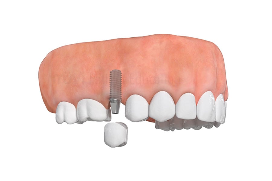 Permanent teeth with a dental implant by Dr. Raffi implant expert in Chicago, IL. Dental Implant in Chicago, IL