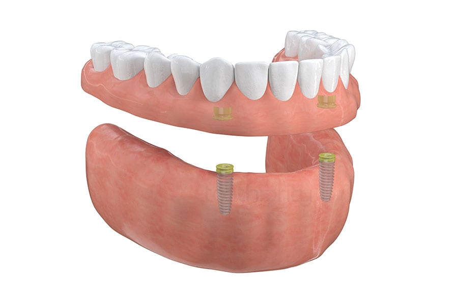 Implant supported overdentures that function as natural teeth Implant-Supported Overdentures in Chicago, IL