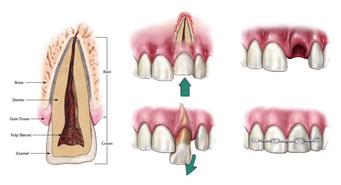 Learn what is considered a traumatic injury in Chicago, IL. Traumatic Dental Injury in Chicago, IL